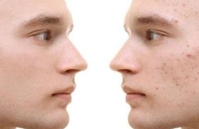 facial anti acne